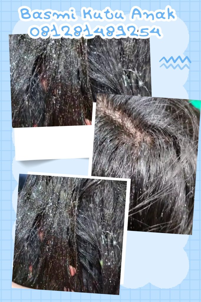 Salon Kutu Di Jatinegara Jakarta Timur