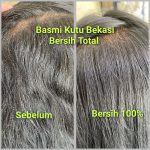 Harga Menghilangkan Kutu Rambut di Salon Bekasi