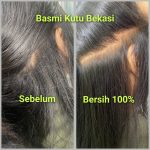 Perawatan Rambut Berkutu di Galaxy Jatiasih Bekasi – Bersih Total Sekali Treatment di Eve Salon
